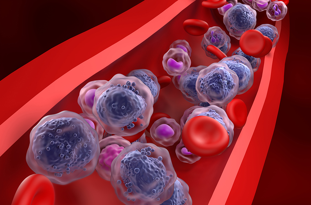 Revumenib with azacitidine + venetoclax in ND NPM1m or KMT2Ar AML