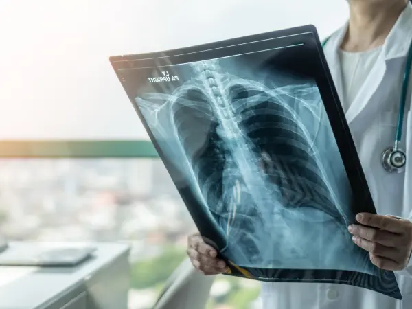 ASSIST CLAD phase II: MSCs for new onset CLAD