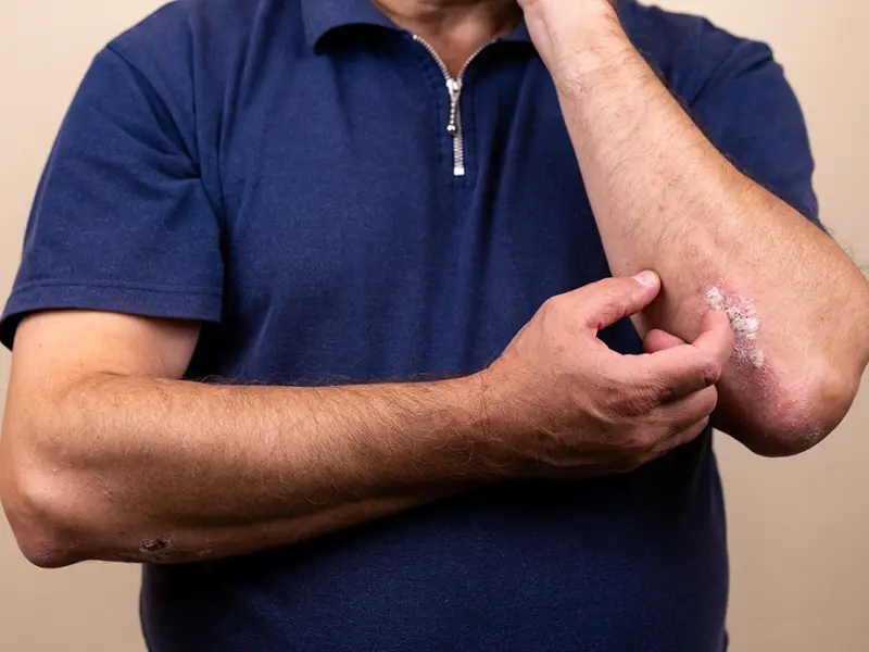 Predictive factors for early super response to bimekizumab in psoriasis: A real-world study