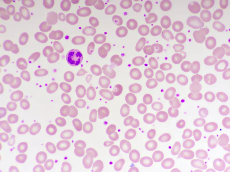 Essential thrombocythemia with platelet count of 1.5 million