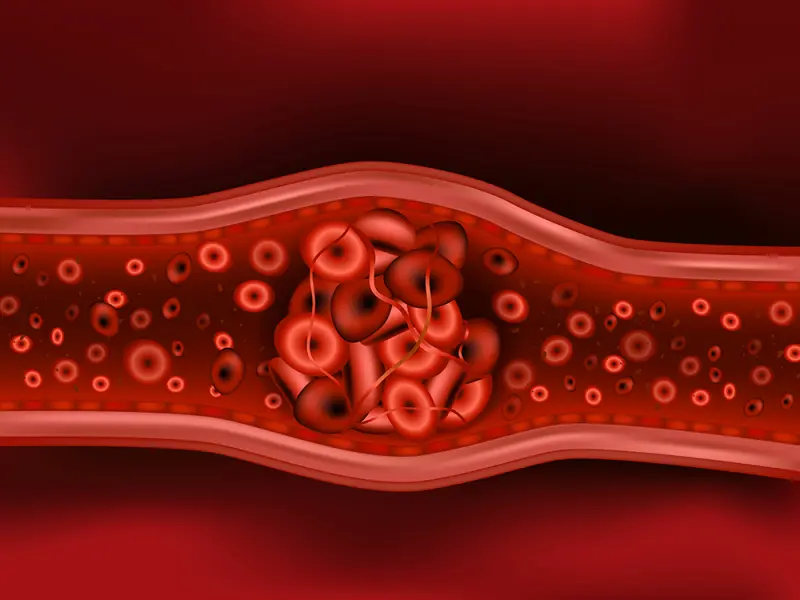 Underutilization of cytoreductive therapies for PV: A German observational study