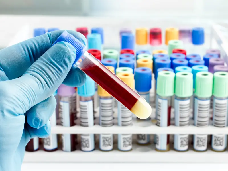 Prognostic impact of a cytopenic phenotype in myelofibrosis