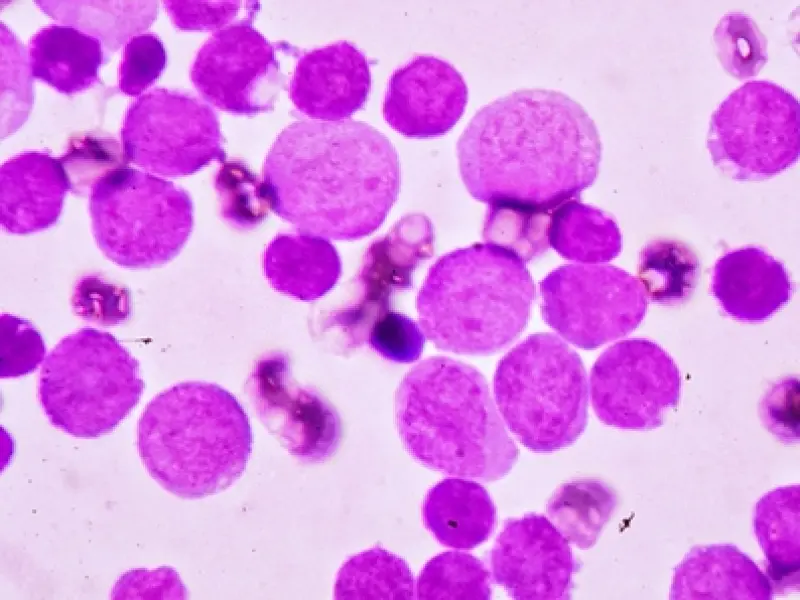 Ivosidenib approved as first-line treatment for AML with IDH1 mutation