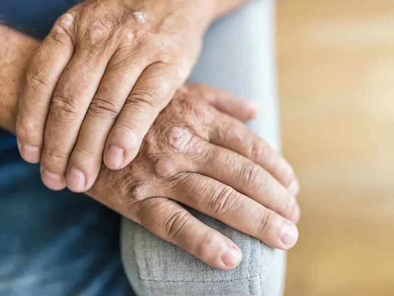 POETYK phase III trials: Pooled analyses of deucravacitinib in psoriatic arthritis