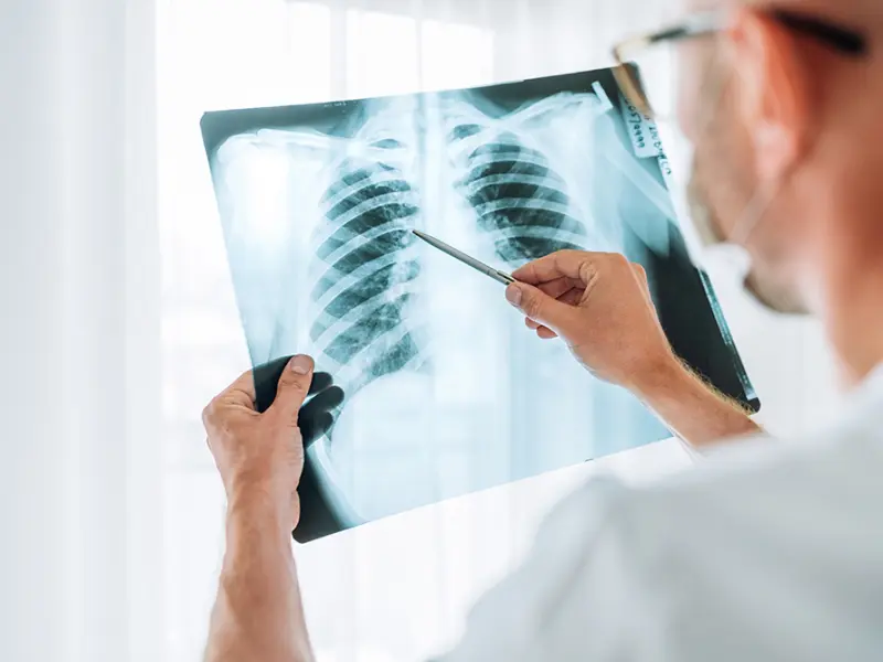 Ruxolitinib for the treatment of BOS after allo-HSCT