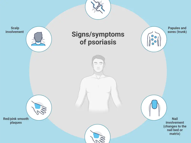 Psoriasis: An overview