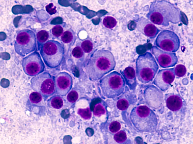 GPRC5D-directed CAR T-cell therapy and bispecific antibodies for patients with RRMM: Latest updates from ASH 2022