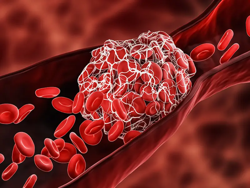 QRISK3 score predicts thrombotic risk in myeloproliferative neoplasms