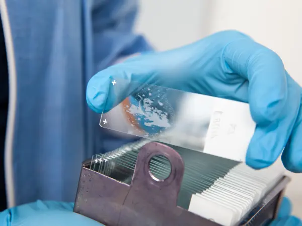 Biopsy-guided cytokine profiling in PsO