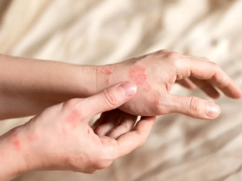 On-treatment remission in plaque psoriasis: NPF Remission Workgroup definition