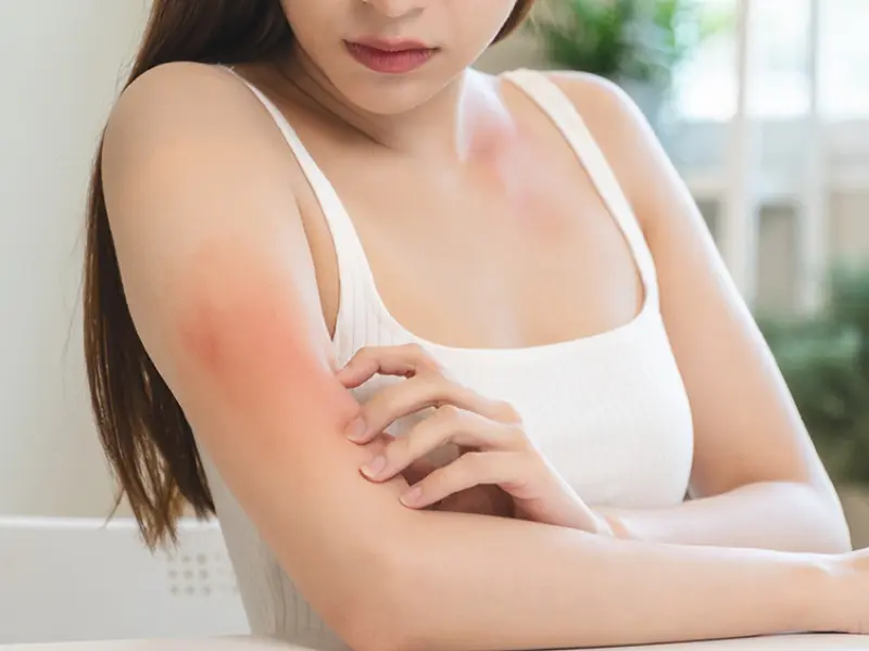 ICONIC-LEAD phase III: Maintenance of response with icotrokinra in moderate-to-severe plaque psoriasis