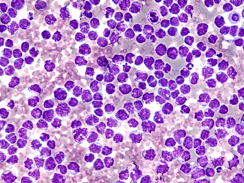 ECHO trial: Acalabrutinib plus bendamustine and rituximab for newly diagnosed older patients with MCL