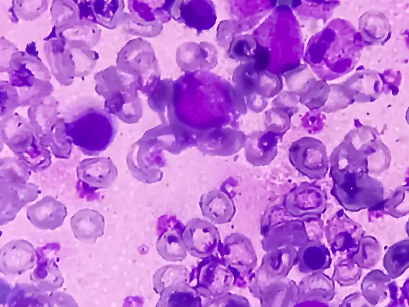 AI-based quantitative bone marrow pathology analysis for MPN