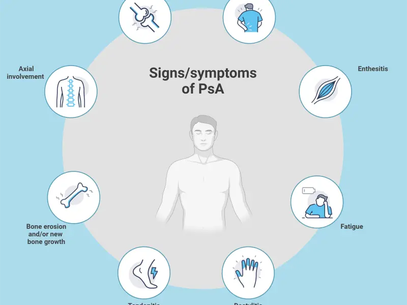 Psoriatic arthritis: An overview 