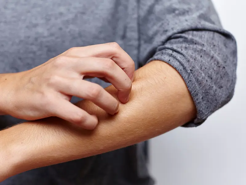 reSURFACE 1 and reSURFACE 2 post hoc analysis: Tildrakizumab in patients with early- vs late-onset plaque psoriasis