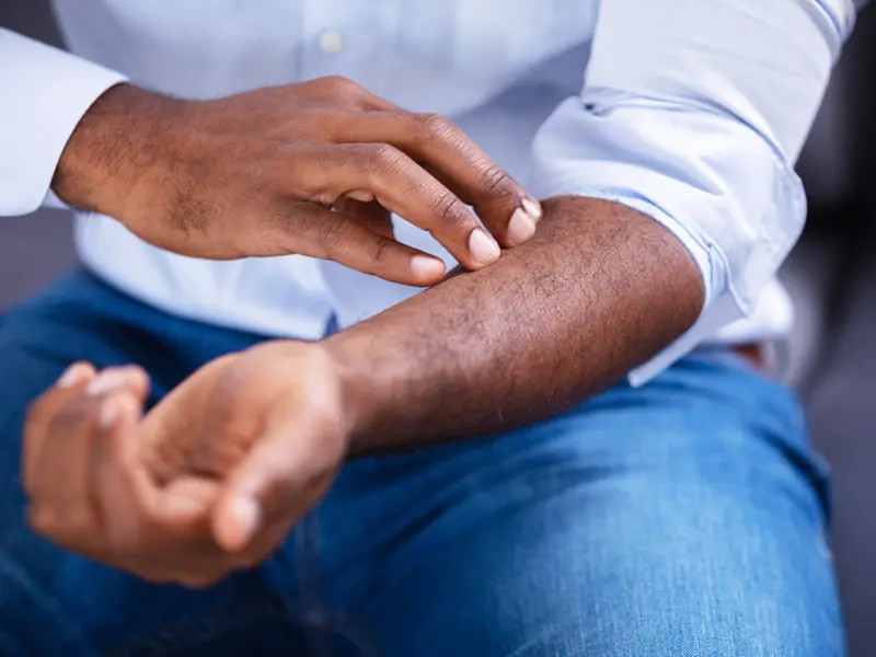 CRYSTAL-Greece: Disease severity and QoL with systemic treatments in psoriasis