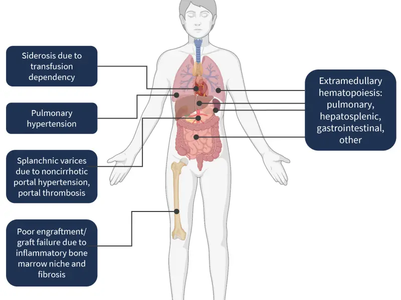Factors affecting transplant outcomes in MF