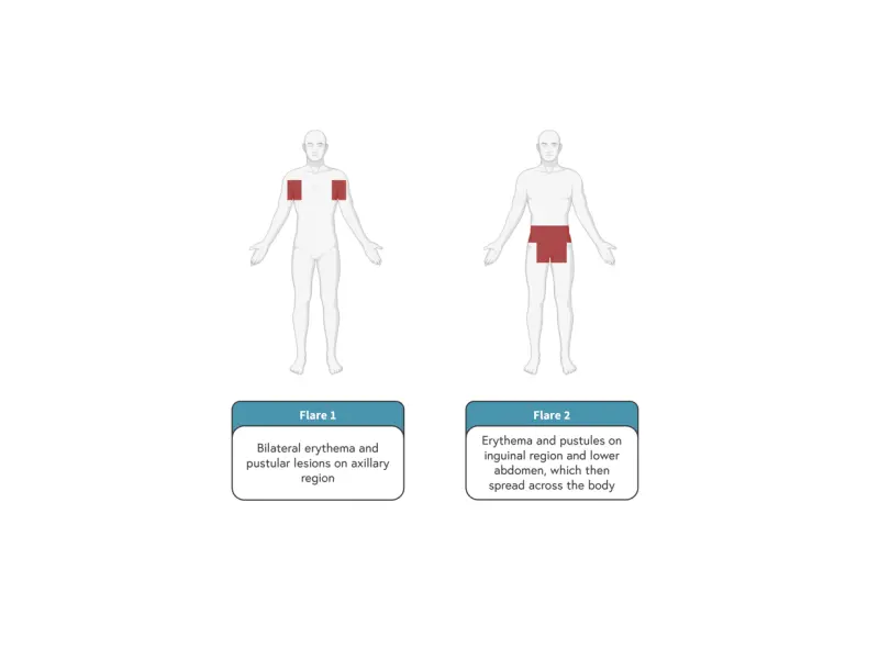 Case study | 53-year-old patient experiencing psoriasis flare after COVID-19 vaccination