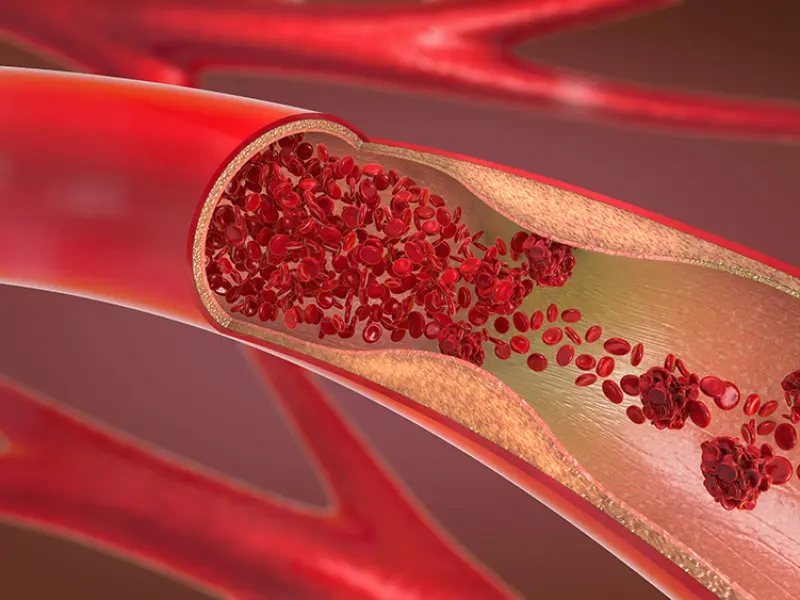 Treatment of thrombotic complications in patients with MPN 